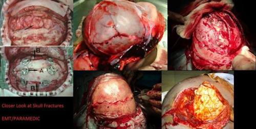 tossingtelevisions: Here we have some nasty skull/facial trauma, looks cleaned up to me. For those o