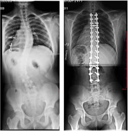 fuckyeahmedicalstuff:  This is a 13 year old girl with progressive double major scoliosis in her thoracic and lumbar spine. X-rays over time showed that her curves were getting bigger. At the time of surgery, she had a 39° curve in the thoracic spine