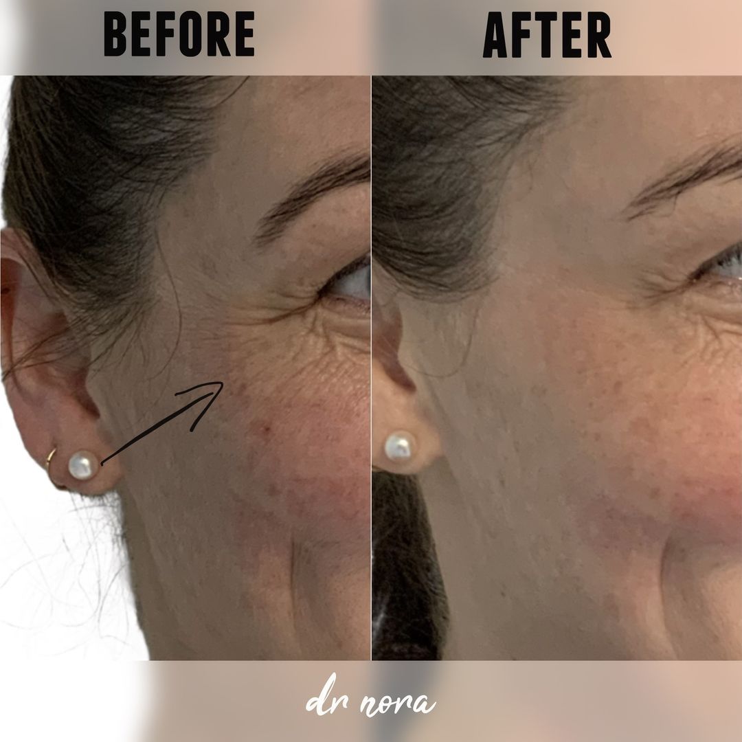 Anti-wrinkle treatment of smile lines 😆Anti-wrinkle therapy is a way to reduce the appearance of strong and deep lines around the eyes. Treatment time is 15 minutes, optimal results are seen at 2 weeks and lasts up to 3-5 months.
If you have any...