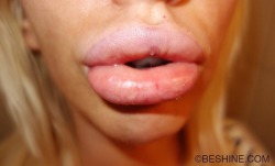 faketitslover999:  darkersideofthestone:  biothickness:  Beshine got her lips done.  The New Average  finally her lips fit her juggs! diese Lippen passen perfekt zu ihren Riesentitten!  Oh ja! Bin mal gespannt ob sie bei ihrem nächsten Titten-Update