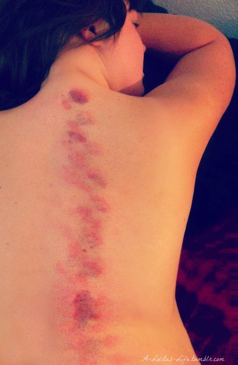 sugarncyanide:  submissivefeminist:  fatfeministfetishist:  pretty-little-hate-doll:  adorablesweetlittlegirl:  privatesubmissive:   Daddy likes to mark what is his… Today Daddy decided he wanted his litle girl to sport pretty little purple bite marks