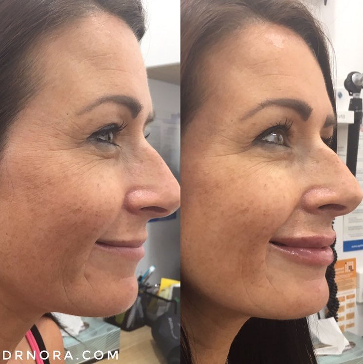 Looking for a fresh look?This beautiful lady had 1ml of dermal filler in her lips with a fantastic outcome!
Her lips are fuller, plumper and look fabulously hydrated. With results expected to last up to 6 months why not treat yourself 💋
If you’re...