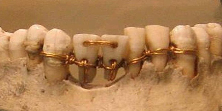mrmckoy702:  pearl-nautilus:  The earliest evidence of ancient dentistry we have