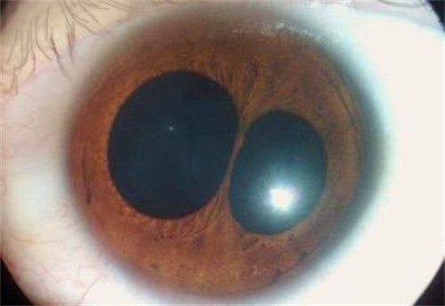  Polycoria - a medical condition of having multiple pupils in one eye. 