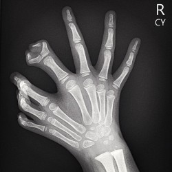 radiopaedia:  Mirror hand (ulnar dimelia)