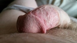 circ-nation:  My circumcised cock  So dry and rubberised