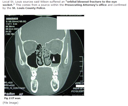 Darren Wilson's "blowout fracture"