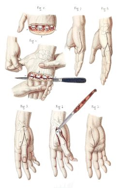 Oldbookillustrations:  Disarticulation Of The Four Fingers And Metacarpals.  Jean-Baptiste