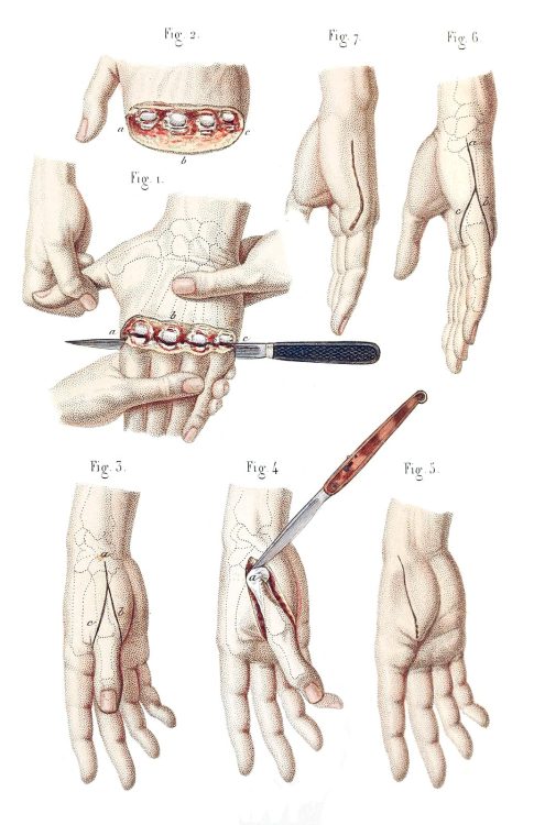oldbookillustrations:disarticulation of the four fingers and metacarpals. Jean-Baptiste Lévei