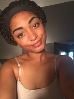 pussy-and-pizzza-x:  captaindjwsgts:  80prooftruth:  asiaamadia:  asiaamadia:  Being comfy with not having perfect skin. 😌   A year later. I look a mess, please ignore it but my skin has gotten better, not 100% but Im getting there.  Still gorgeous