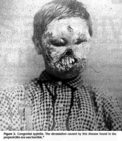 Congenital syphilis, pre penicillin (it was a devastating disease).