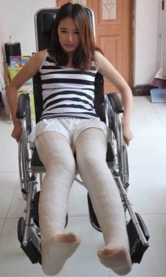 Double Long Leg Cast In Wheelchair Dllc