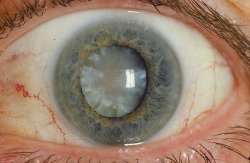 voulx: A hypermature age-related cortico-nuclear cataract with a brunescent (brown) nucleus. + 