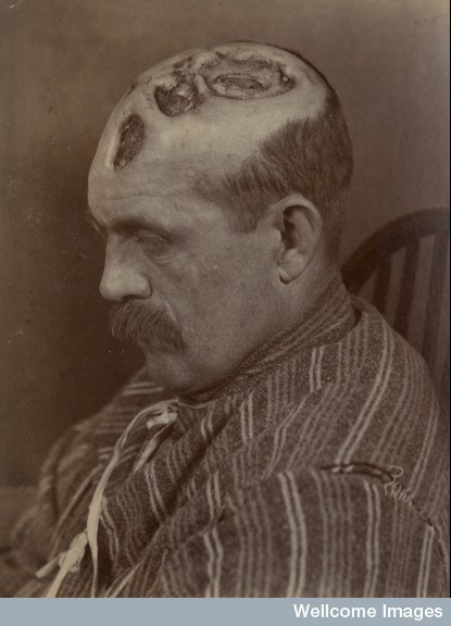 thechirurgeonsapprentice:Tertiary syphilitic ulceration of the scalp (19th century). 