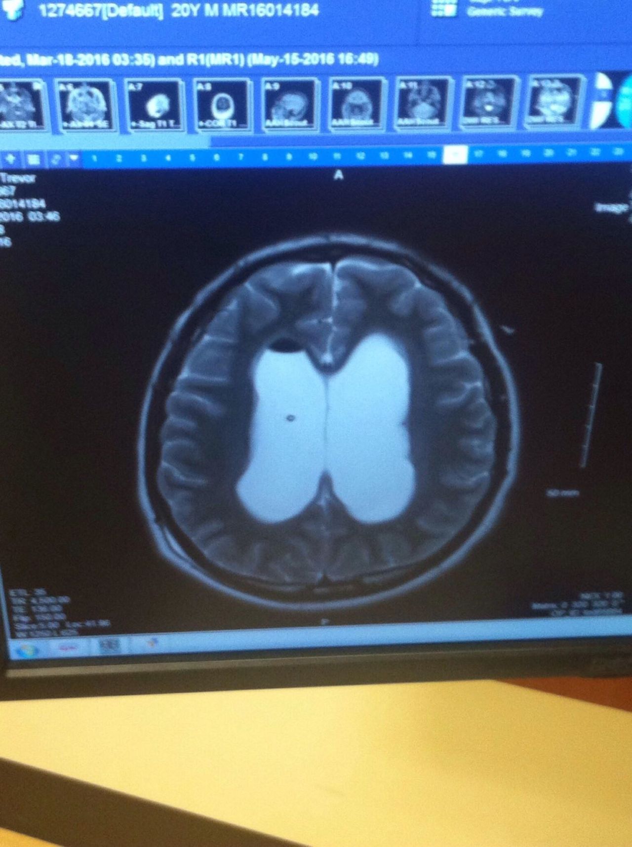 humanberry:  justsomeantifas:  My little brother has brain cancer We found out in 2016: see that little dot piece of shit, that’s the cancer that has been destroying his life,  he has Ŭk of medical expenses medicaid wont cover because the government