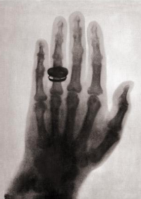 dj-froge:sixpenceee:First Human X-ray 1896. The woman, Marie Curie, who took part