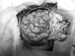 thelovablecorpse:  Brain surgery to treat epilepsy  