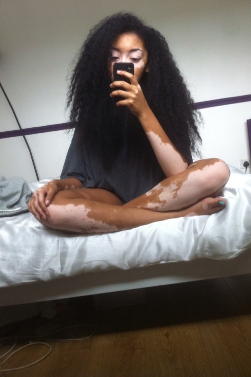 yung-eastafricangirl:  helicoptxrs:  shaniquadontplay:  She is so beautiful.  my mom has Vitiligo an