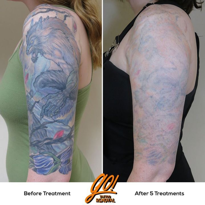 What Should You Know About Tattoo Removal  Pasadena Cosmetic Surgery