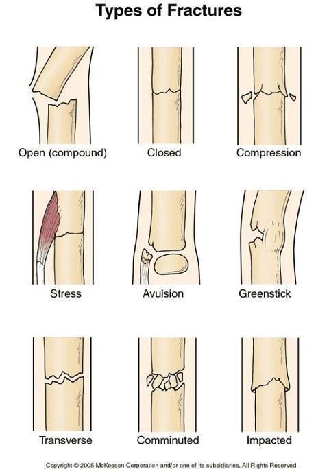 Porn photo dreamteam2016:  fractures 