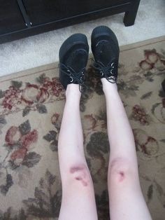 intoxicated-with-the-madness:  Bruised thin legs ❤