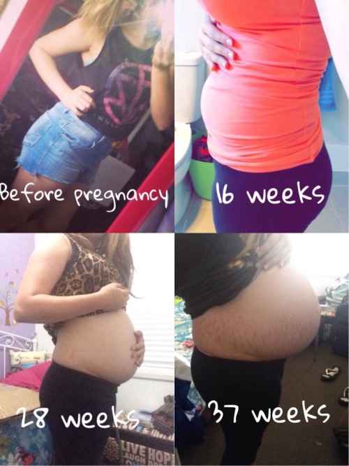 teen-mummy-diary:Before I was pregnant, I never took photos showing my stomach only when I got my 