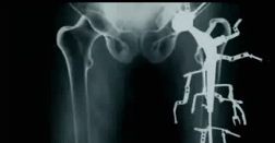 sixpenceee:  Metalosis Maligna is a fake disease invented by award-winning Dutch filmmaker Floris Kaayk. According to the mockumentary, Metalosis Maligna occurs when a metal implant has a bad interaction with human body tissues, causing the metal to grow