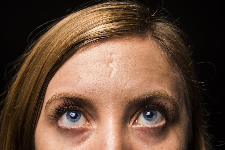 huffingtonpost:  24 Women Bare Their Scars To Reveal The Beauty In Imperfections“It’s