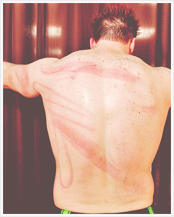 w4de-barrett:  Sheamus getting treated for his welts.  OUCH!!!