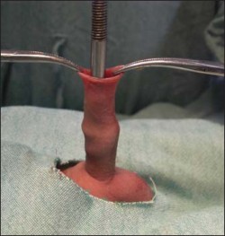 studsnpuds:  Circumcision using a Winkelmann Clamp. They’re made in adult sizes and the wingnut allows for a tighter clampdown on the doomed foreskin. Also there is more room for running the blade around, and better visualization of the amount of skin