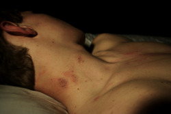 paintdeath:  Hickies. by Heatherheartbeat on Flickr. 