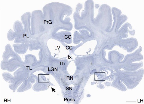 neuromorphogenesis:After Death, H.M.’s Brain Uploaded to the CloudThe most famous neuroscience patie