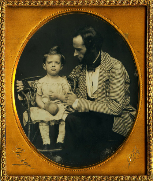 ca. 1854, [daguerreotype portrait an injured child with their father and a bandaged hand]via Macrafl