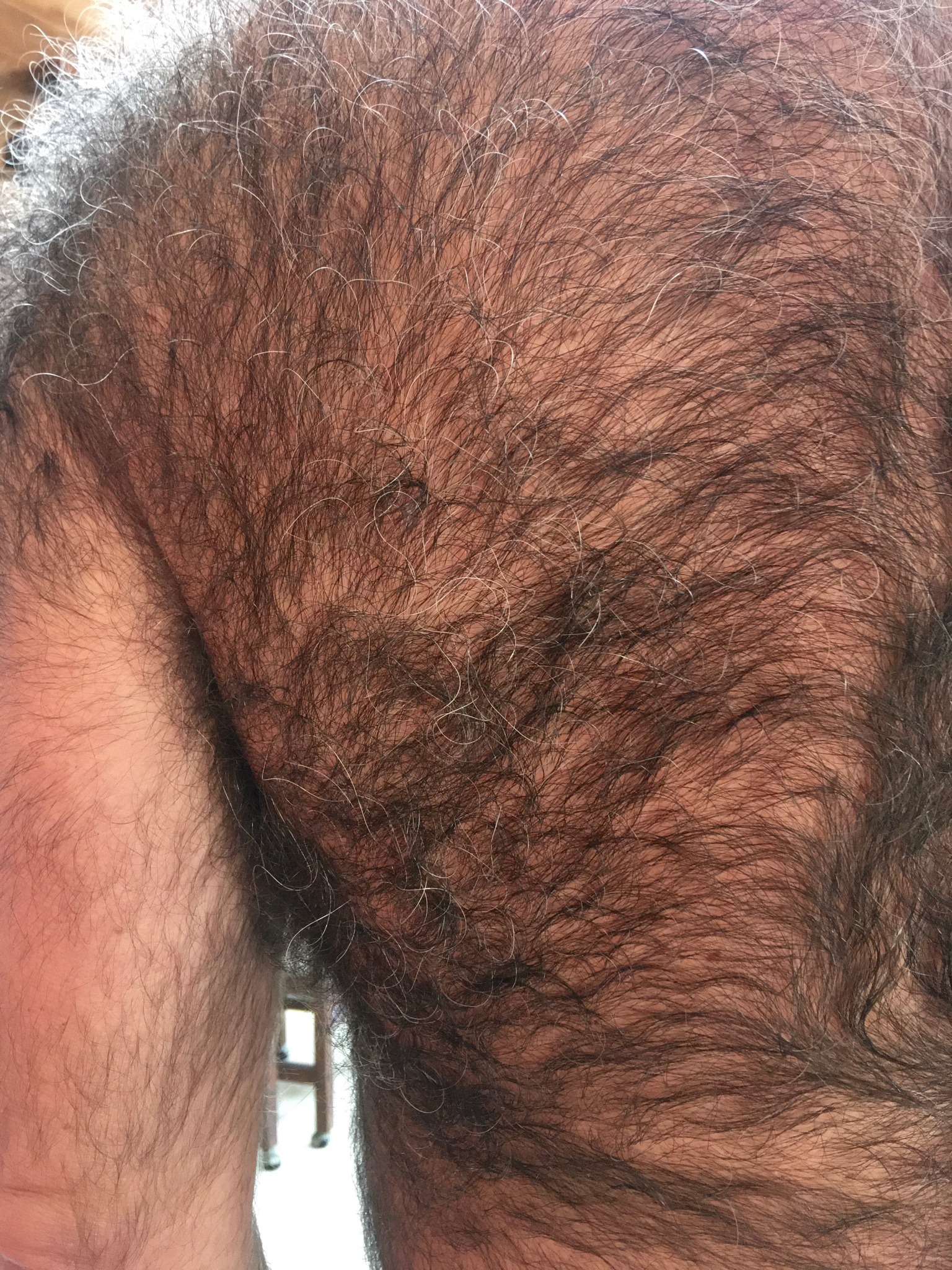 extremehairymen:maxhair:So why do I get more comments about the back fur?￼Because