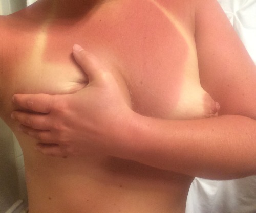 showmywife:  She got a little too much sun.