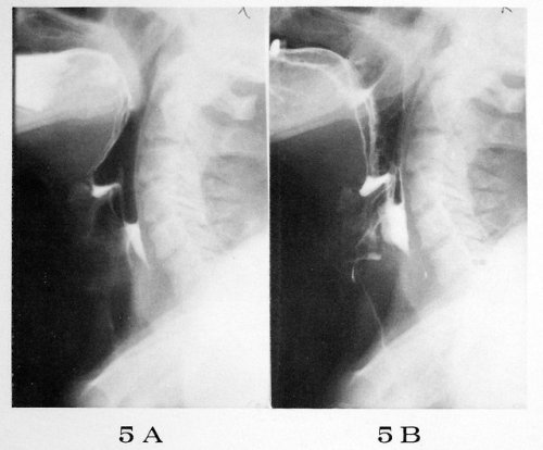 Radiograph of a patient swallowing water with a soluble radiopaque substance mixed into it, c.1971. 