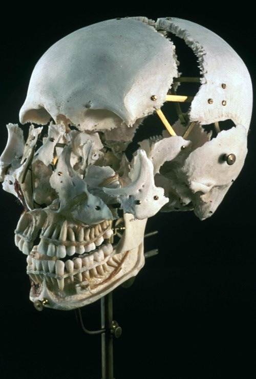 jack089:  Exploded and dissected skulls. Beauchene Skull - Mounted preparation of