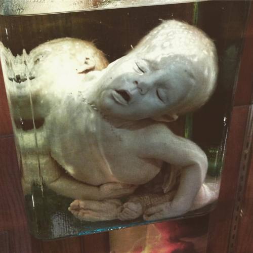 scioddities:  Another little souvenir from the #muttermuseum : Siamese babies #medecine #wetspecimen