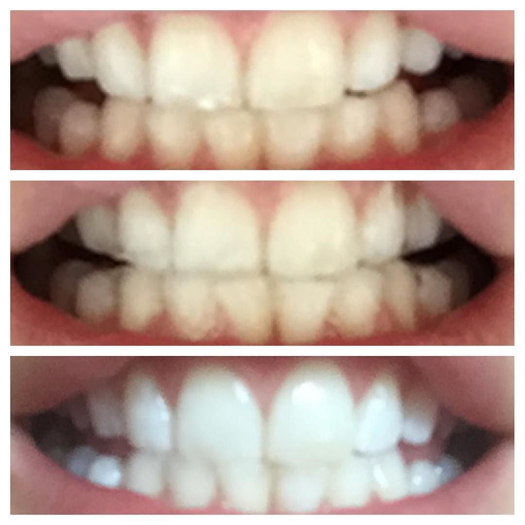 We @laseredbeauty are now stocking teeth whitening strips!  I&rsquo;ve just sampled