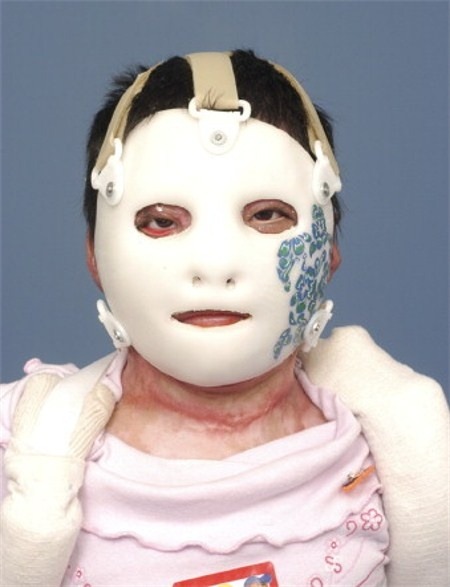 Face mask on a burn patient. Facial burns disrupt anatomical and functional structures creating pain, deformity, swelling, and contractures that may lead to lasting physical and psychological sequelae. The management of facial burns may include operative