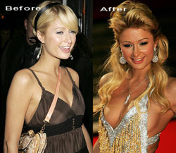 Paris Hilton #Nsfw #Beforeandafterboltons