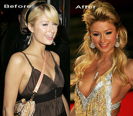 Porn photo paris hilton #BeforeAndAfterBoltons