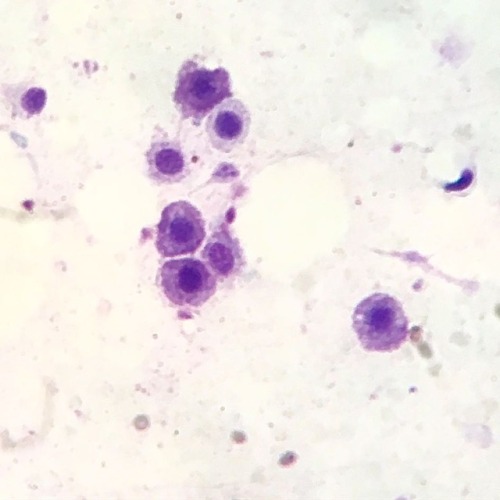FNA (fine needle aspirate)of a cutaneous mass on the side of an...