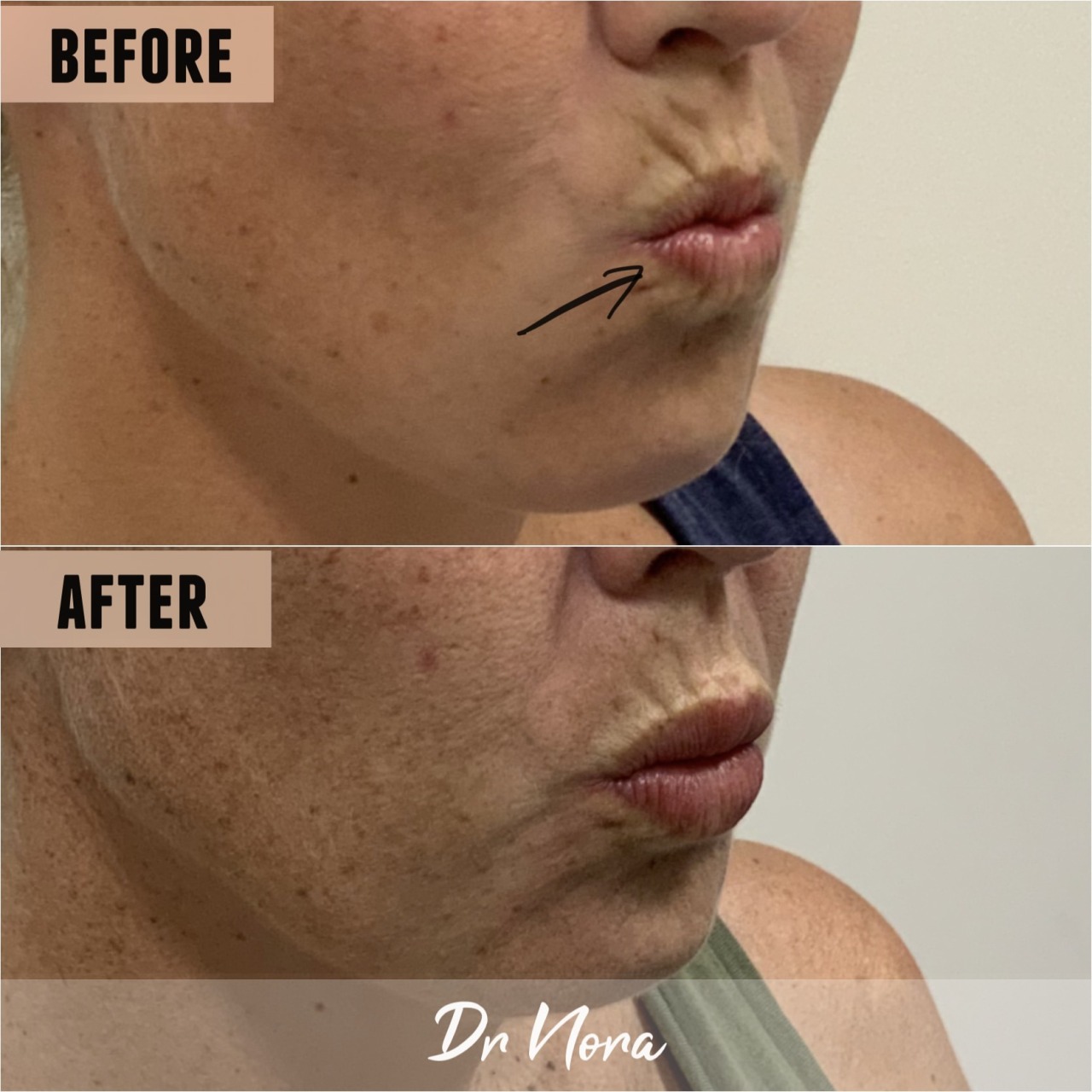 1ml lip filler 👄Treatment time is around 20 minutes and swelling and bruising is seen straight after settling at around 3-5 days with optimal results at 2 weeks.
If you’re interested in finding out more or to book, head over to drnora.com.
Take care...