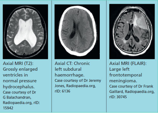 Can You See Alzheimers On A Ct Scan - Ellie Matthew's Blog