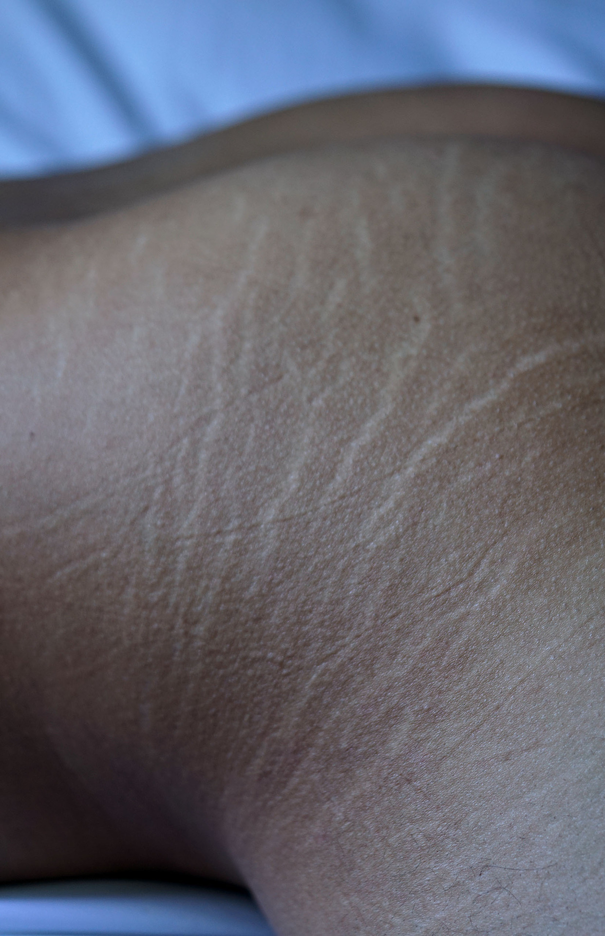 poopingiscute:  You hate your stretchmarks but I love them. 