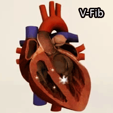 flyonthewallmedstudent:  dieselotherapy:  Ventricular Tachycardia (V-Tach)  Ventricular