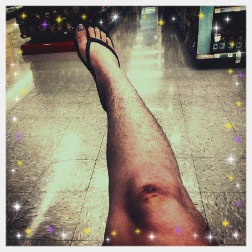 veryhairylegs: my hairy Italian legs and my busted knee