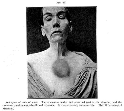 A classic presentation of syphilitic aneurysm of the aortic arch.