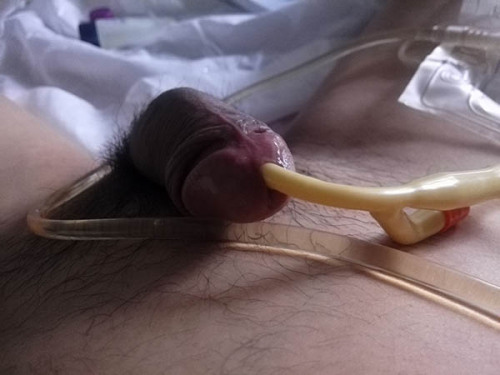 Sex Catheter lovers pictures